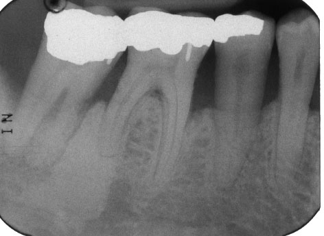 Focal Idiopathic Osteosclerosis – Dr. G's Toothpix