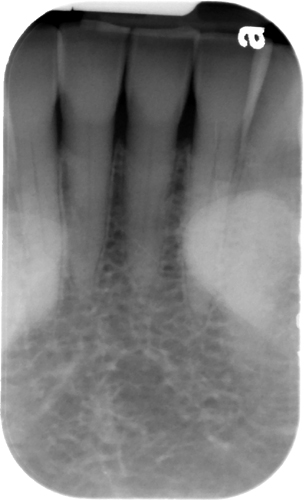 Mandibular Tori – Dr. G's Toothpix