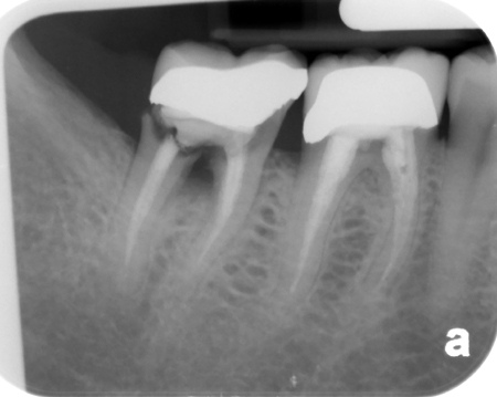 Root fractures – Horizontal – Dr. G's Toothpix