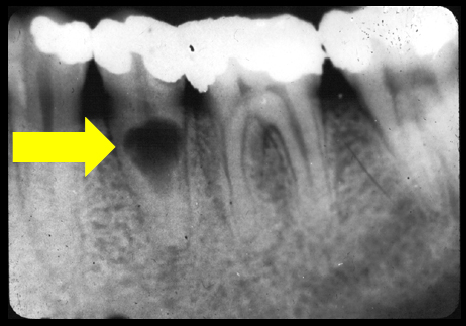 Internal Resorption – Dr. G's Toothpix