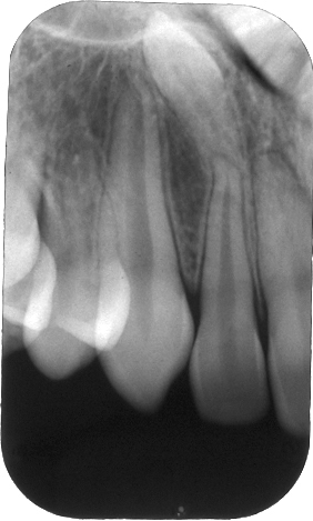 Case of the Week: Mesiodens – Dr. G's Toothpix