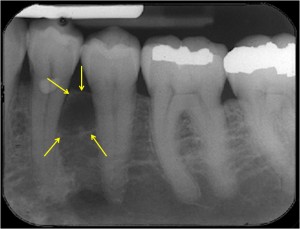 Lateral Periodontal Cyst Dr G S Toothpix