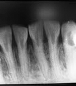 Radicular Dentin Dysplasia