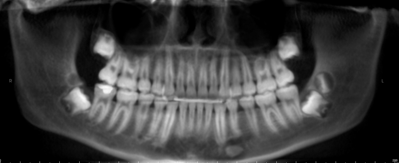 distodens – Dr. G's Toothpix