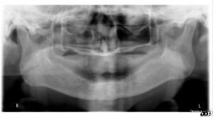 Anatomy Monday Lingual Foramen Mandible Dr G S Toothpix