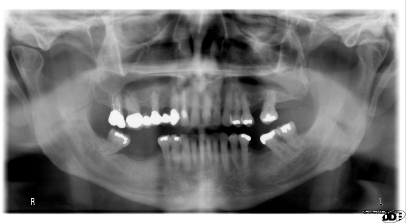 Case of the Week: Mesiodens (supernumerary tooth) – Dr. G's Toothpix