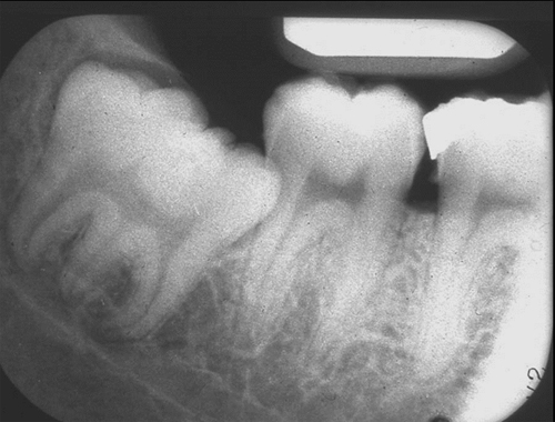 Gemination – Dr. G's Toothpix