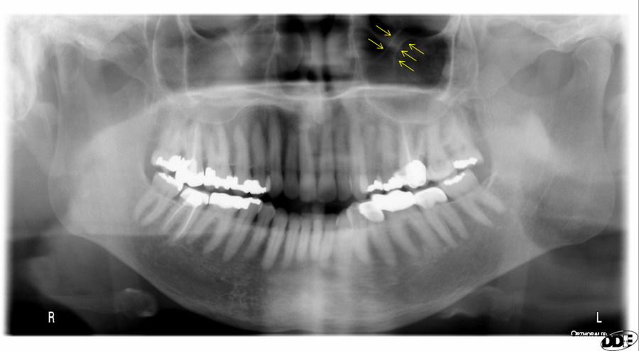 infraorbital canal – Dr. G's Toothpix