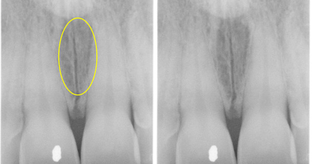 incisive foramen | Dr. G's Toothpix