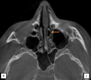 Anatomy Monday: Concha Bullosa – Dr. G's Toothpix