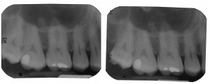 Antral Exostoses / Antral Projection – Dr. G's Toothpix