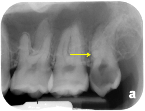 Enamel Pearl – Dr. G's Toothpix