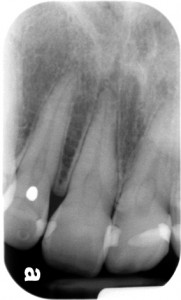 Pulp Stone – Dr. G's Toothpix
