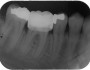 Pulp Stone – Dr. G's Toothpix