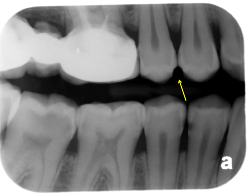 Case of the Week: Abrasion – Dr. G's Toothpix