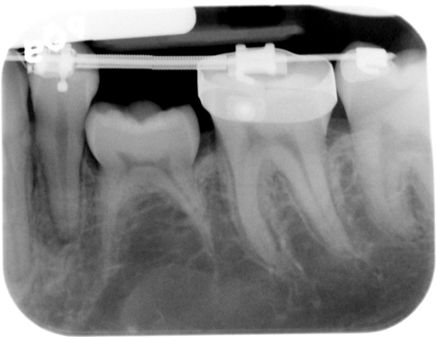 Ankylosis – Dr. G's Toothpix