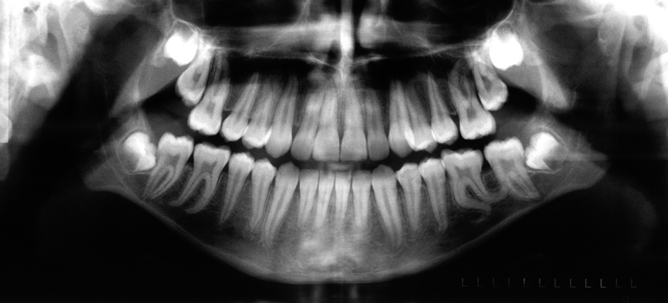 Снимки рта. Кривой зуб мудрости рентген. Ортопантомография зуб мудрости. Панорамный снимок кривых зубов.