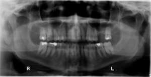 Ossified Stylohyoid Ligament – Dr. G's Toothpix