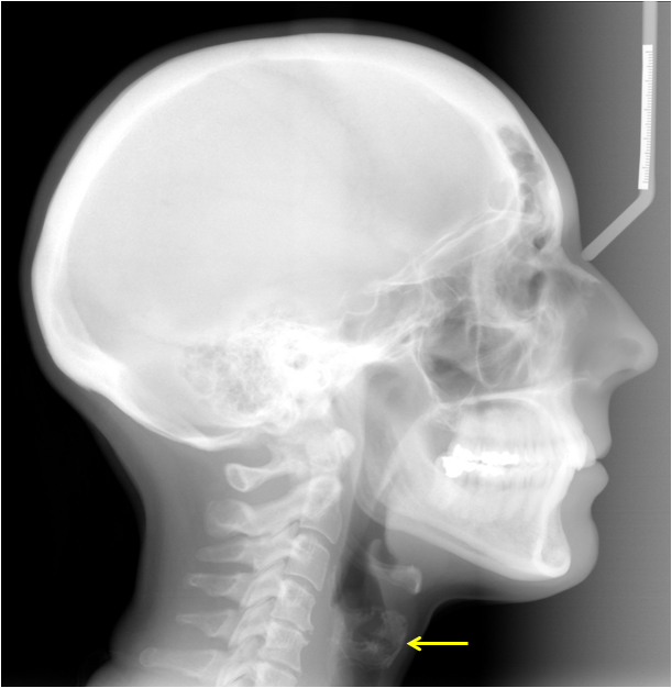 Thyroid: X Ray Thyroid