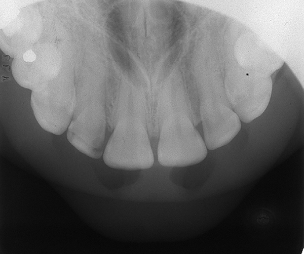 Nasopalatine Canal Cyst – Dr. G's Toothpix