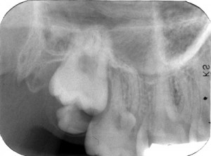 Case of the Week: Supernumerary tooth (Distodens) – Dr. G's Toothpix