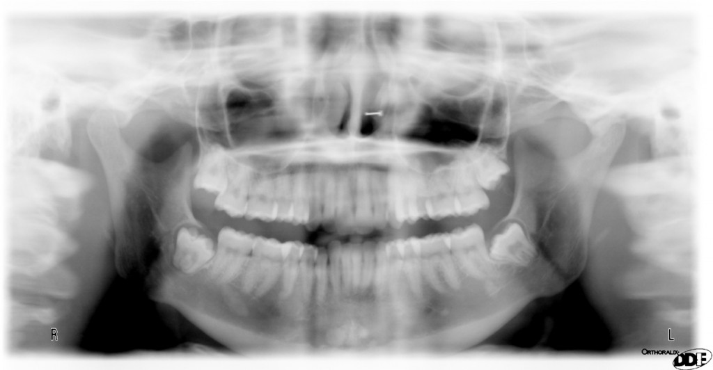 twinning – Dr. G's Toothpix