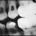 dentin dysplasia type 2 bitewing