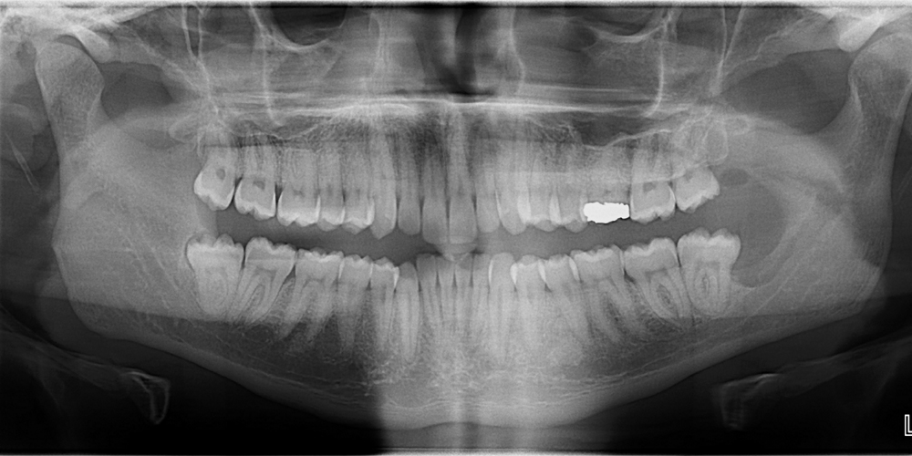 Case of the week: Normal pantomograph imaging mimicking disease