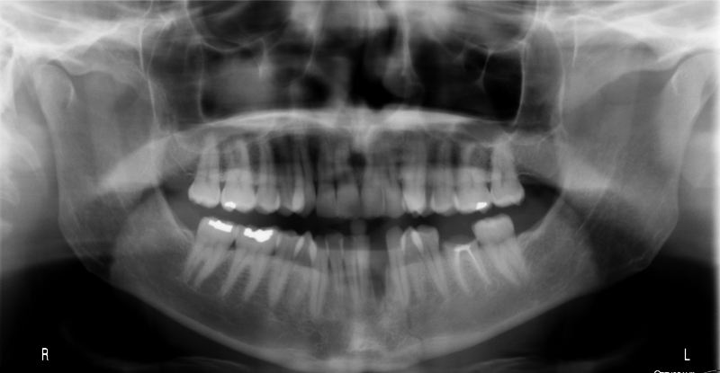 Case of the week: Mandibular Fracture