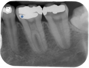 SLOB rule (Same-Lingual, Opposite-Buccal) using vertical angle changes ...