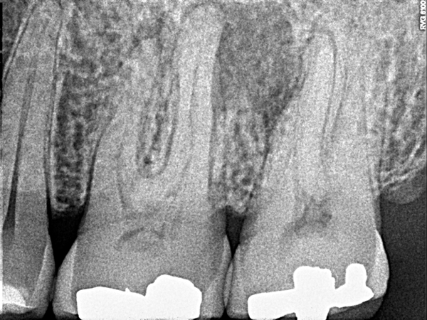 Case of the week: Apical Periodontitis (Apical Rarefying Osteitis)