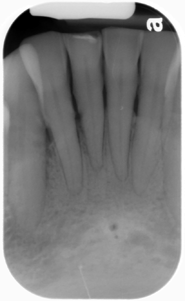 Case of the week: Double Lingual Foramina