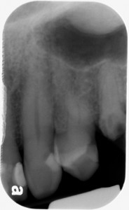 Y line of Ennis with palatal tori