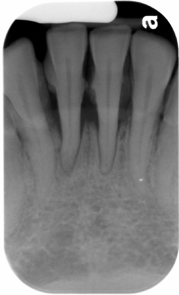 calculus radiograph