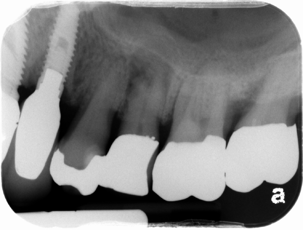 How was that missed? (Chronic Apical Periodontitis / Rarefying Osteitis)