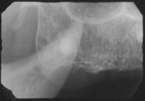 coronoid process and hamulus periapical radiograph