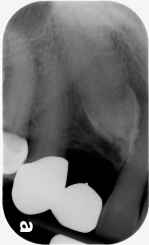 external resorption impacted maxillary canine periapical radiograph 2