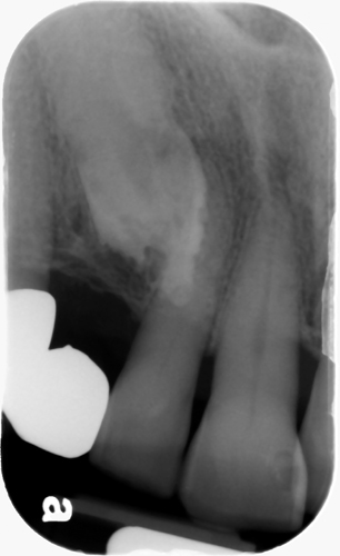 external resorption impacted maxillary canine periapical radiograph