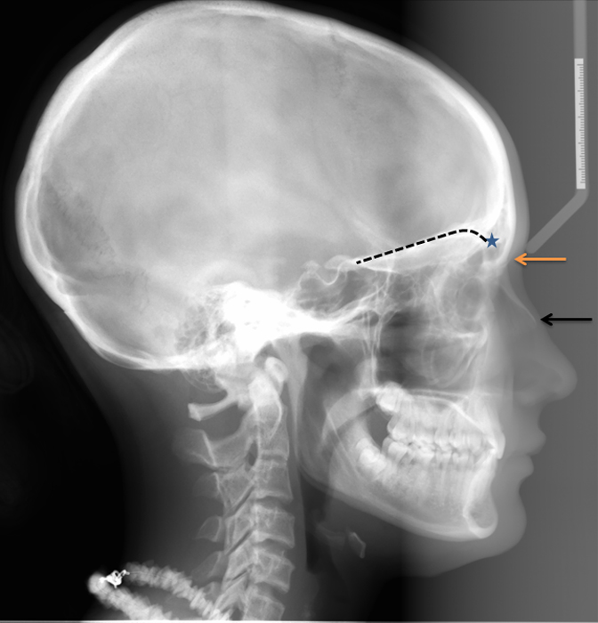 lateral cephalometric skull radiograph animations part i