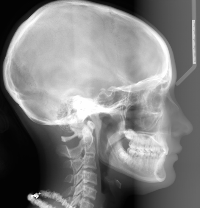 lateral cephalometric skull radiograph part i