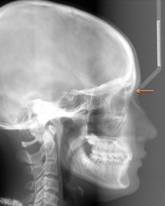 nasion lateral cephalometric skull radiograph