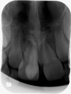 supernumerary tooth periapical radiograph