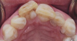 talon cusp clinical photo maxillary central incisor