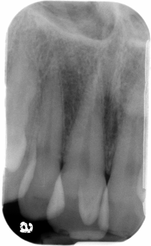 talon cusp periapical radiograph maxillary central incisor
