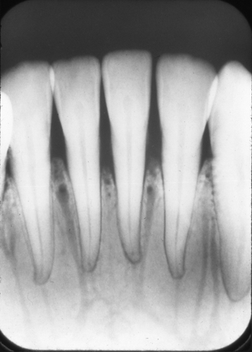 vascular canals periapical radiograph