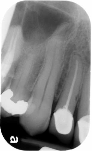 lateral incisor horizontal root fracture 1