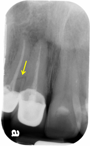 lateral incisor with arrows