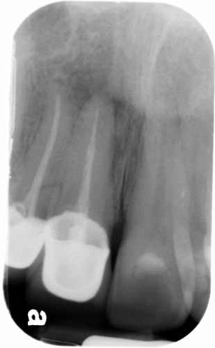 lateral incisor root fracture visible