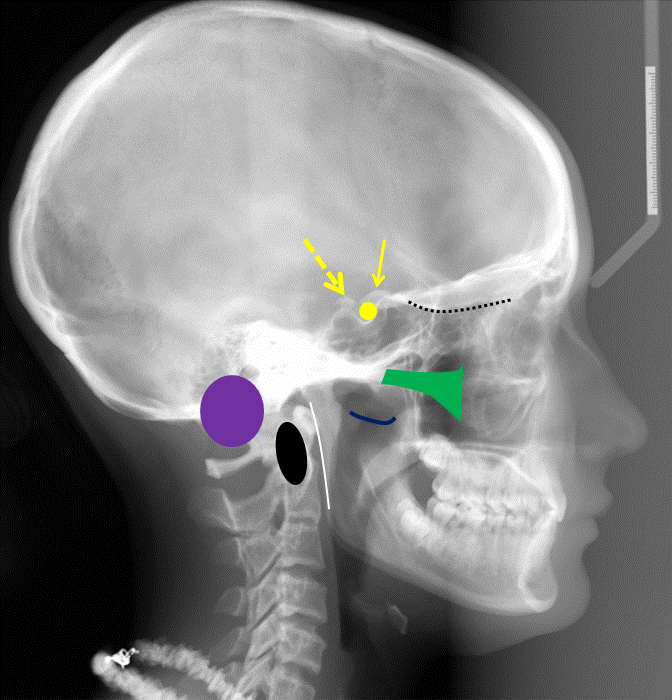 lateral cephalometric skull 3 radiograph with animations