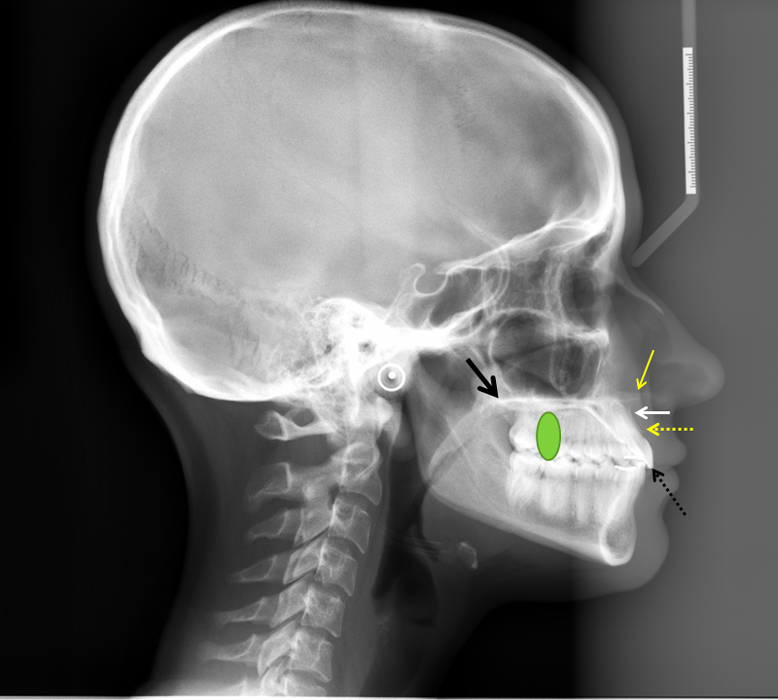 lateral cephalometric skull anatomy maxilla with animations